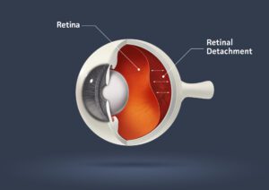 An illustrated diagram of what the inside of the eye looks like when there is retinal detachment. 